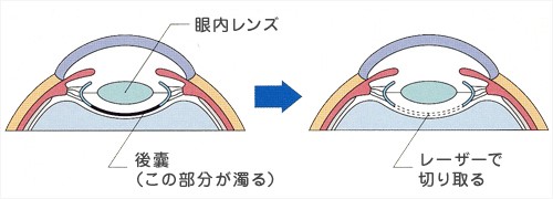 後発白内障について