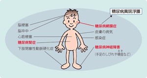 糖尿病網膜症（糖尿病黄斑浮腫）とは