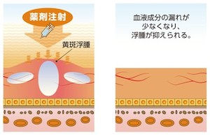 抗VEGF薬治療とは