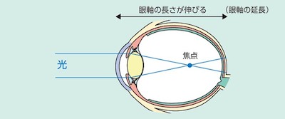 日本人の失明原因疾患