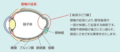 日本人の失明原因疾患